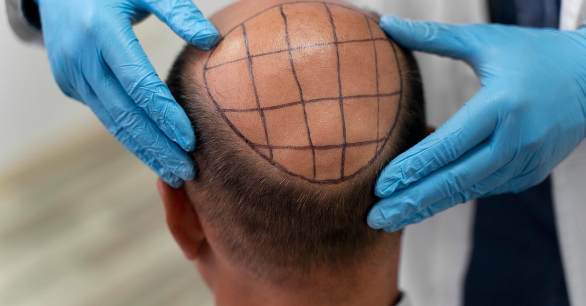 Greffe de cheveux quelles sont vos options featured